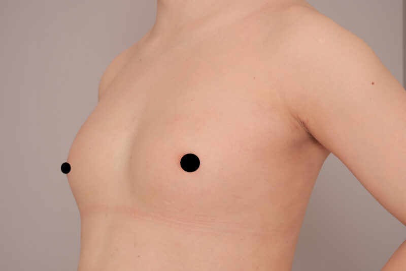 ホルモン治療なし性転換なしの元男性の脇肉の脂肪吸引と豊胸1ヶ月後♪