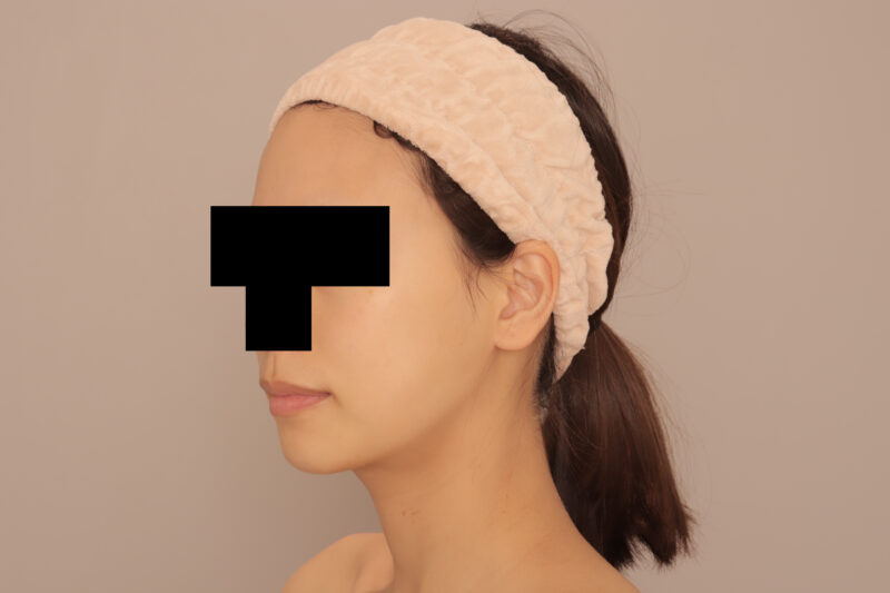 頬顎脂肪吸引で女優顔♫モニター様3ヶ月後