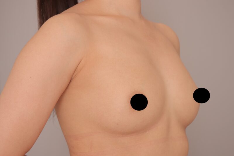 ベイザー脂肪吸引（6ヵ月経過：27）の術後写真