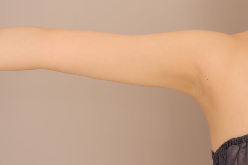 二の腕を華奢ラインに♪二の腕肩の脂肪吸引半年後