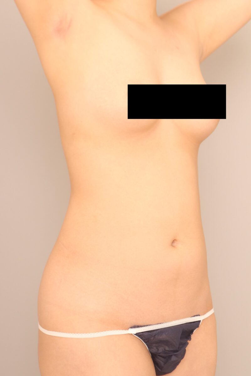 ベイザー脂肪吸引（3ヵ月経過：21）の術前写真