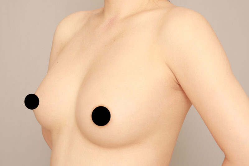 2回コンデンスリッチ豊胸をされたモニター様の変化♡