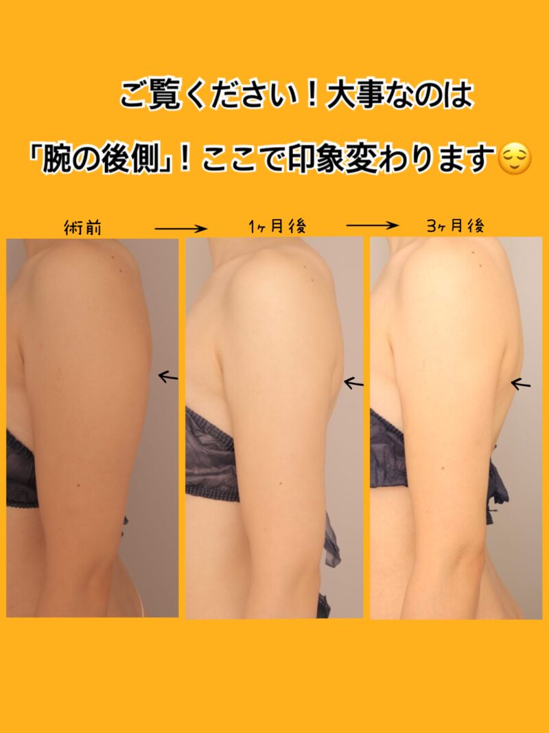 時系列でお見せします！腕の背中側の膨らみを細く！～30歳160cm54kg上腕肩800cc吸引後時系列～～