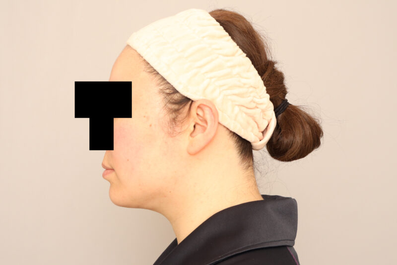 頬顎脂肪吸引でお顔も小さくなり、フェイスラインがしっかり変わったモニター様6ヶ月後♪