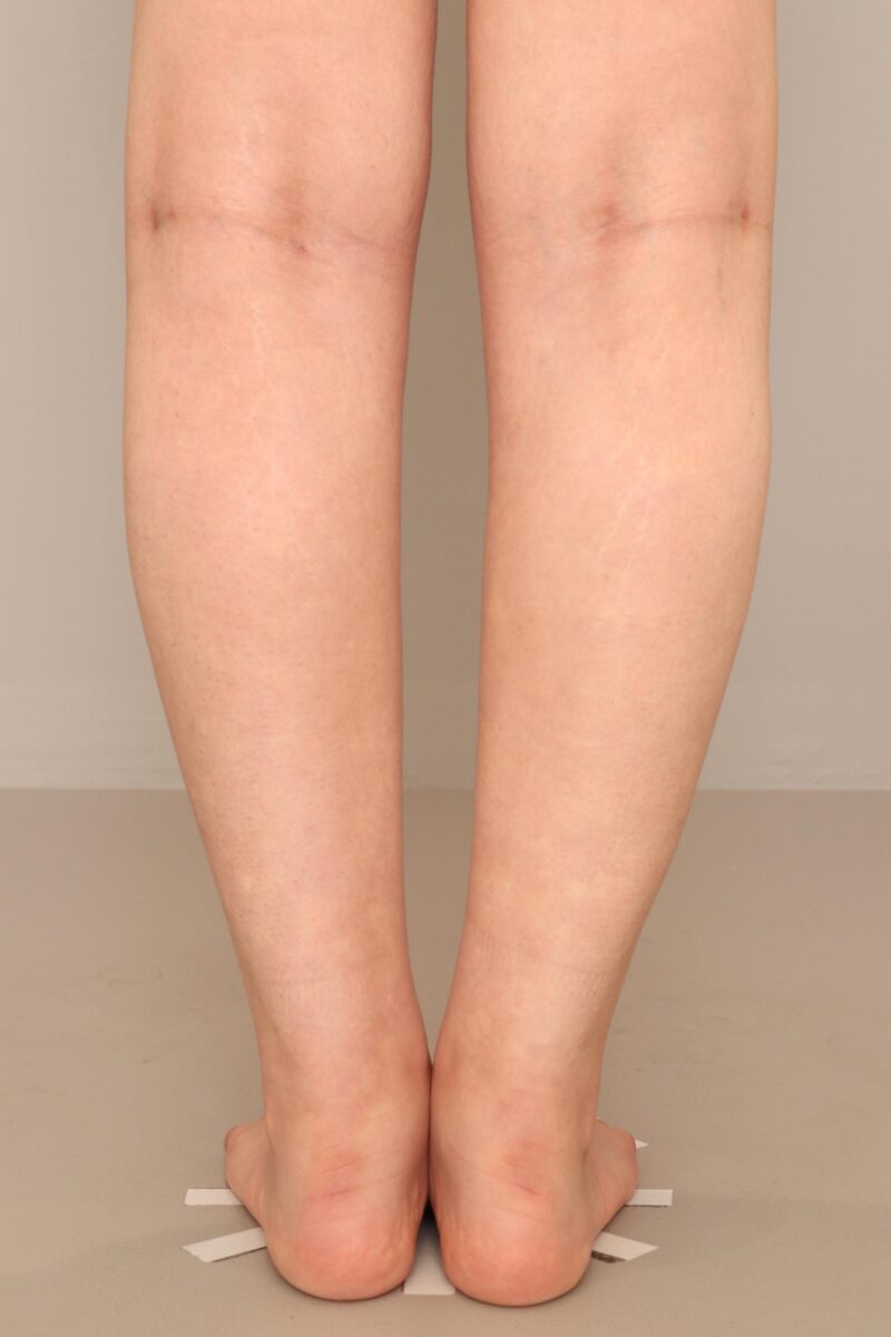 下腿足首の脂肪吸引3ヶ月後♡