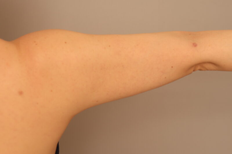 大量吸引の二の腕全周、脇肉の脂肪吸引1ヶ月後の変化♡