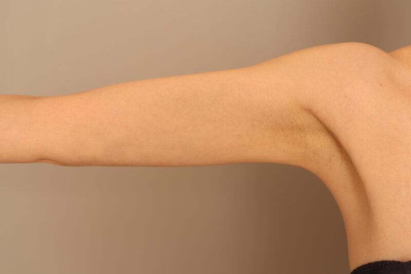細いけどだらんとした二の腕が気になる、とおっしゃっていたモニター様の二の腕、肩の脂肪吸引3ヶ月後♡