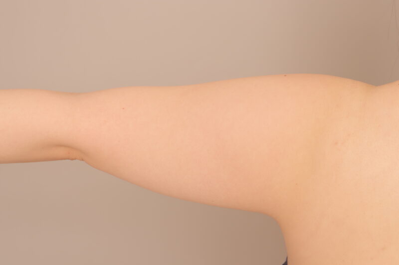 BMI29　20代女性　二の腕を細くしたいです。　