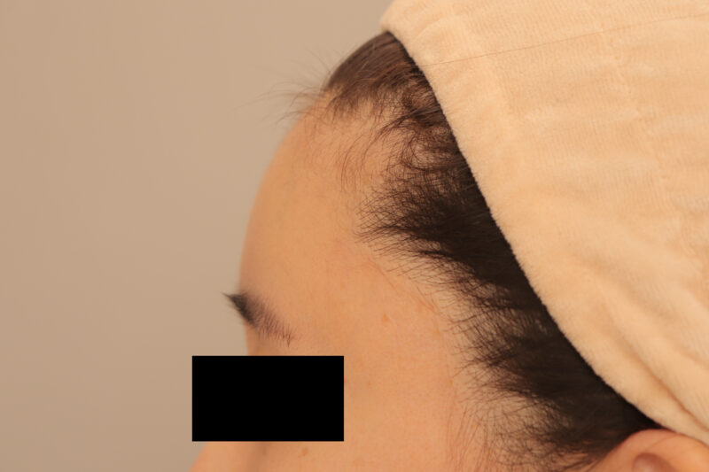 おでここめかみの脂肪注入で、まぁるいおでこ♡