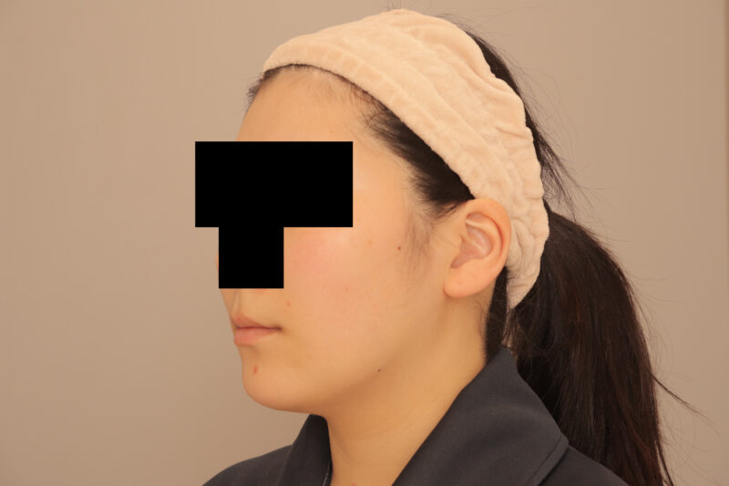 頬顎脂肪吸引でまっすます美人さんに♡6ヶ月後