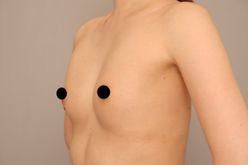 コンデンスリッチ豊胸半年後の4ヶ月後♡