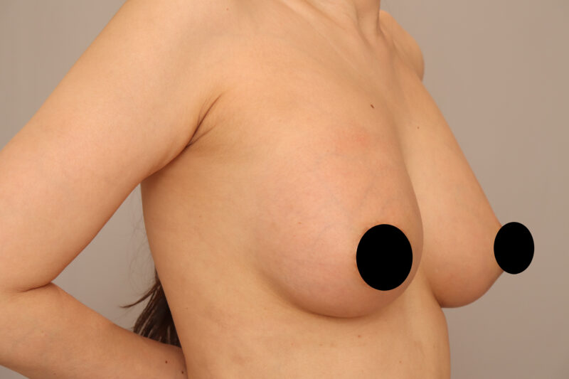 痩せ型だけど2回豊胸でバービー人形のようになった40歳モニター様