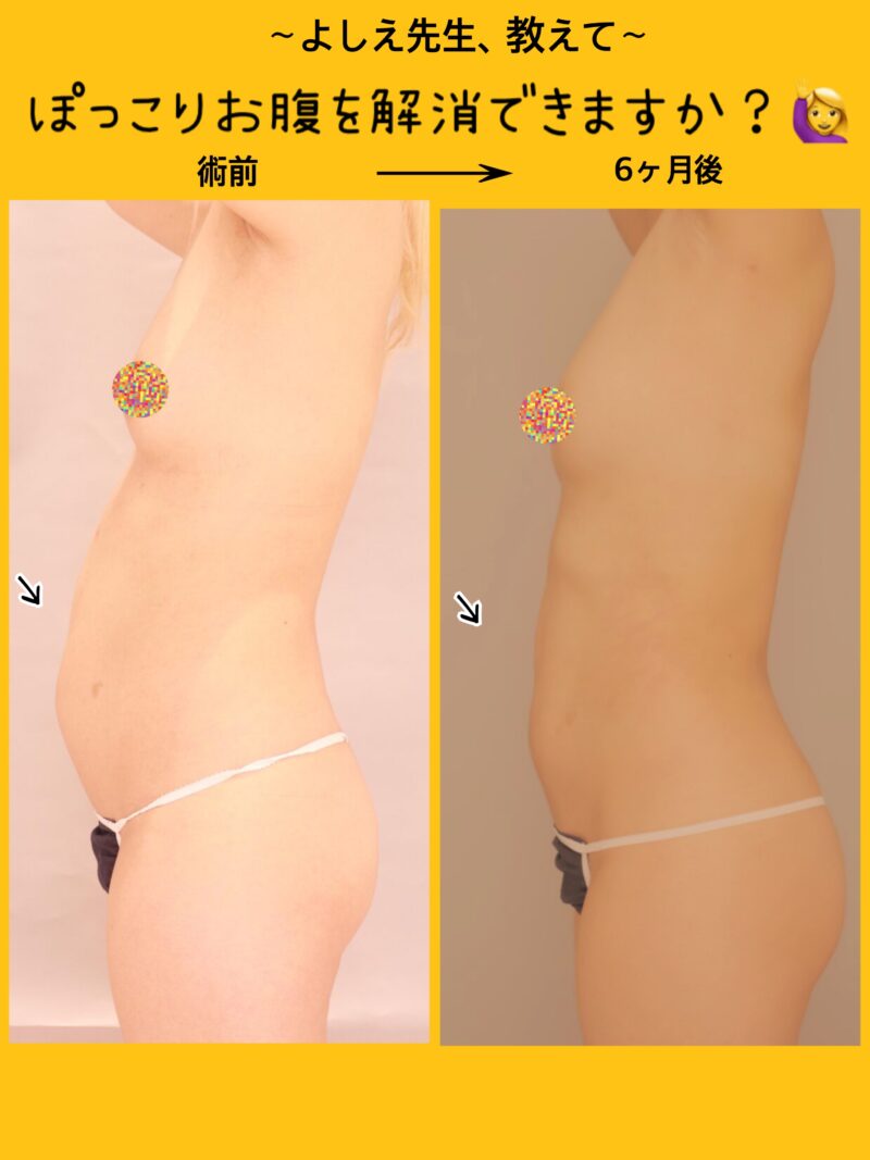 ベイザー脂肪吸引（半年後経過：33）の術前写真