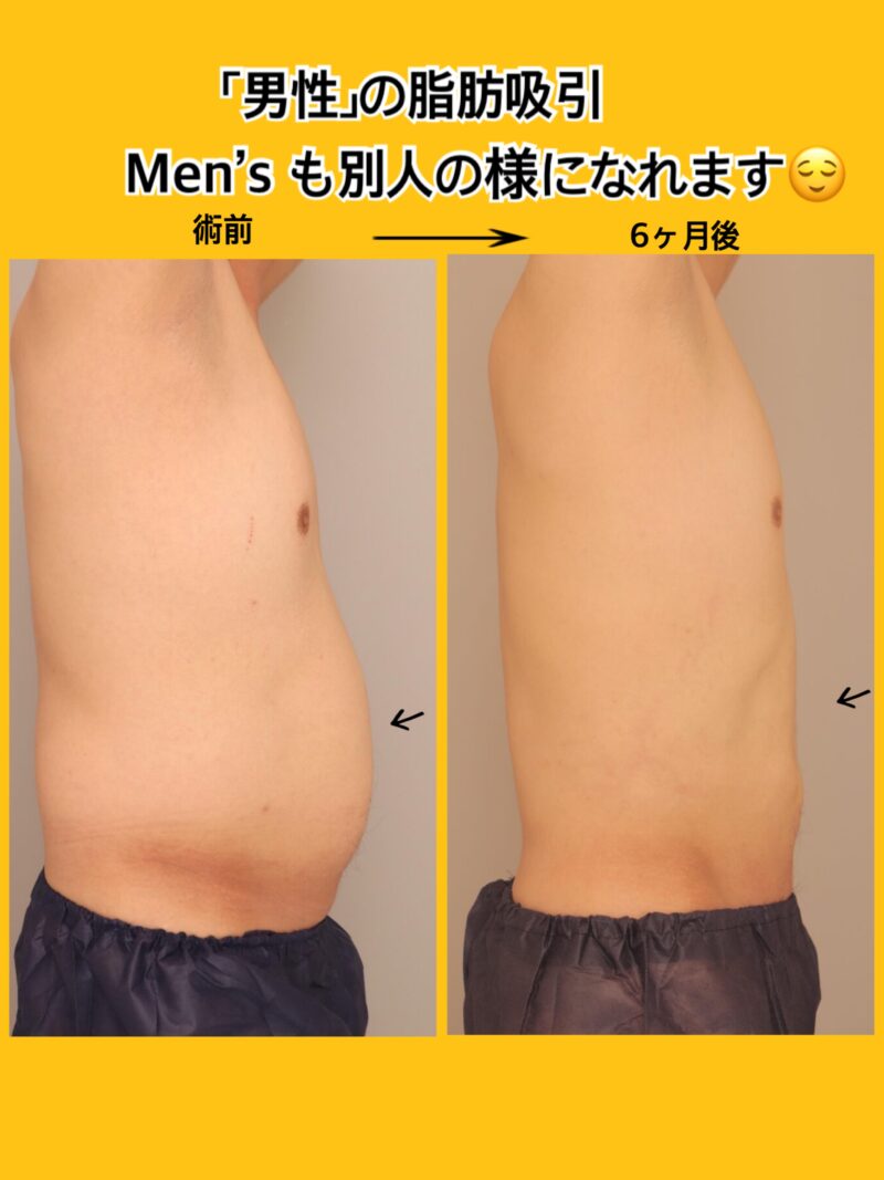 「男性」の脂肪吸引。Men’s のお腹周り、別人の様に、がっつり細く！～44歳162cm66kg腹部全体胸下腰2300㏄吸引後半年～