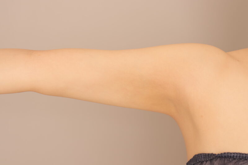二の腕の脂肪吸引半年後♡