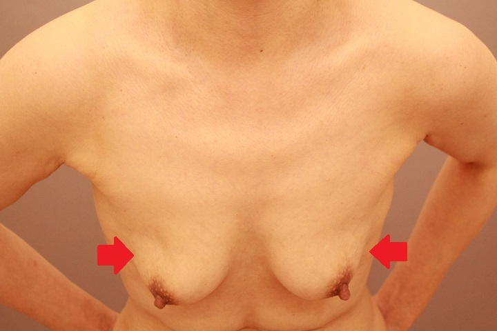 コンデンスリッチ豊胸　半年後