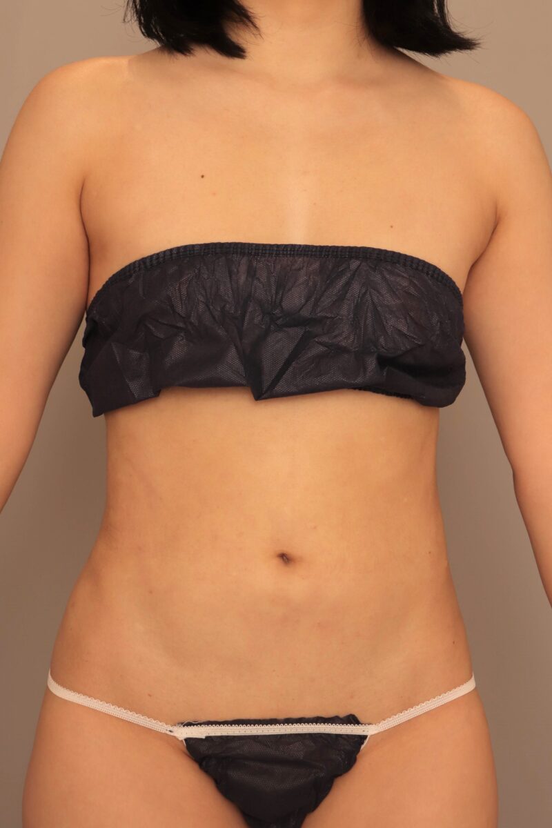 お腹腰乃脂肪吸引からのコンデンスリッチ豊胸3ヶ月後♡