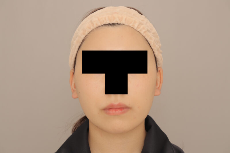 頬顎吸引のモニター様半年後♡