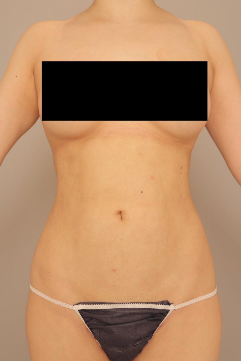 お腹の脂肪吸引3ヶ月後♪よりクビレたセクシーなボディに♡