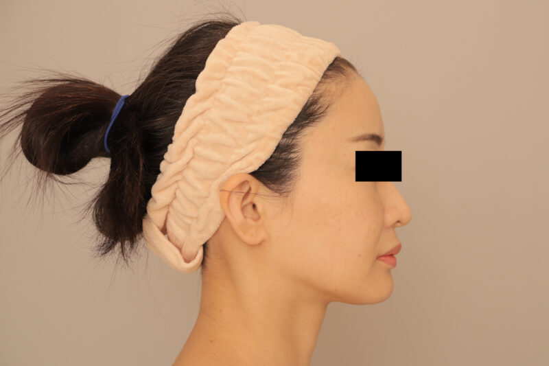 おでここめかみ注入でまああるいおでこ♪より可愛らしい印象に♡1ヶ月後