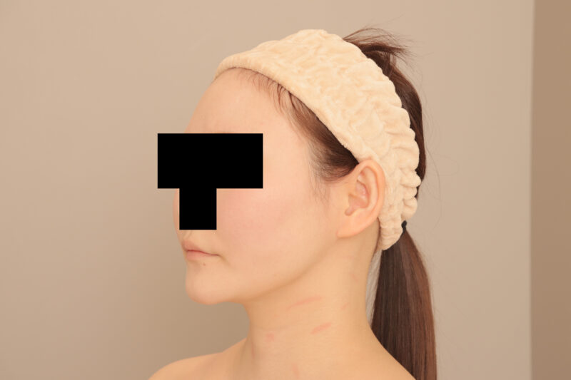 ほぼ全身の脂肪吸引を担当させて頂いたモニター様3ヶ月後①顔