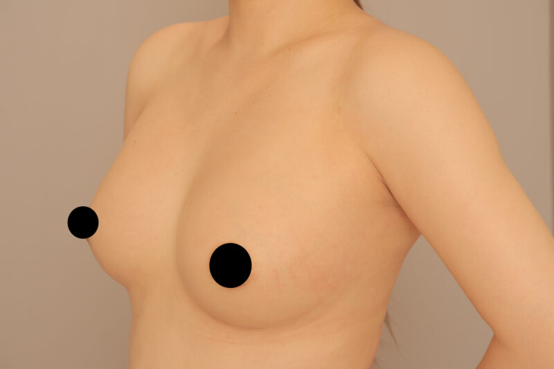 コンデンスリッチ豊胸のモニター様1年後♡