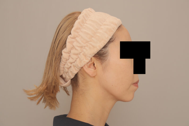 頬顎脂肪吸引で若返り♡41歳モニター様3ヶ月後♪