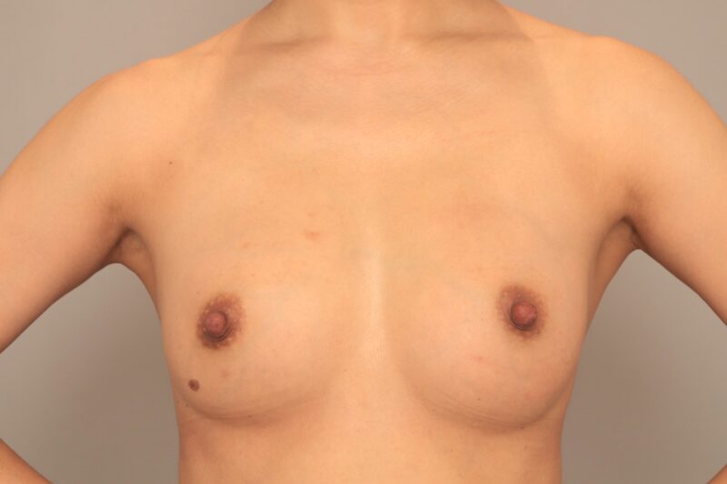 コンデンスリッチ豊胸でふっくら美バスト♡