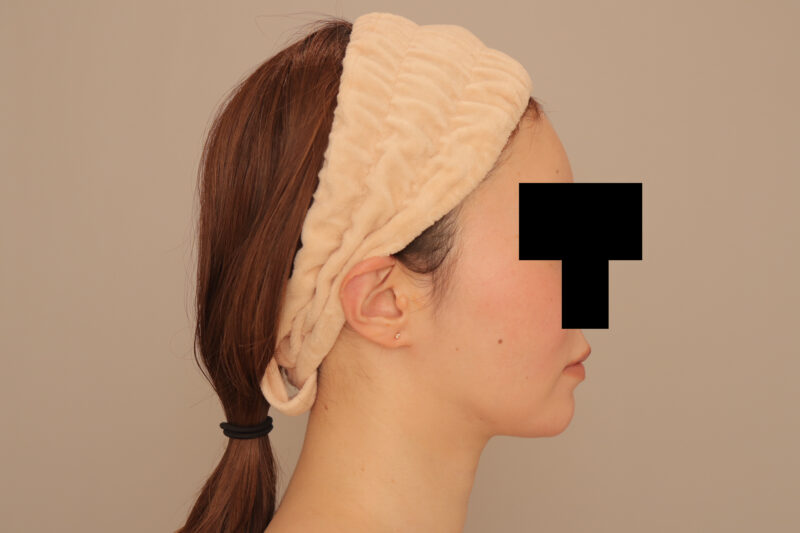 年齢とともに気になってきたフェイラインを整える!頬顎脂肪吸引3ヶ月後♪