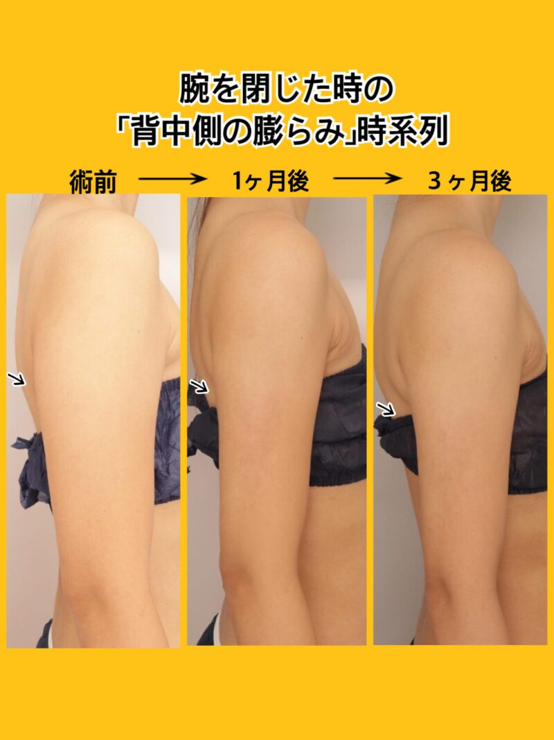 時系列でお見せします！ 腕の背中側の膨らみ、肩からストンっな細腕に　 ～34歳 166cm50kg 上腕肩脇肉 700㏄吸引後時系列～