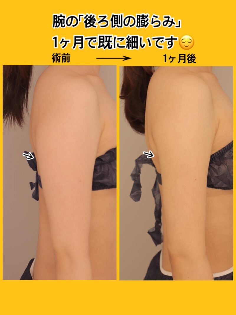 一ヶ月で、腕の後ろ側の膨らみはすでに細い！ここから更に細くなります～24歳159cm51kg上腕肩500cc吸引後1ヶ月～