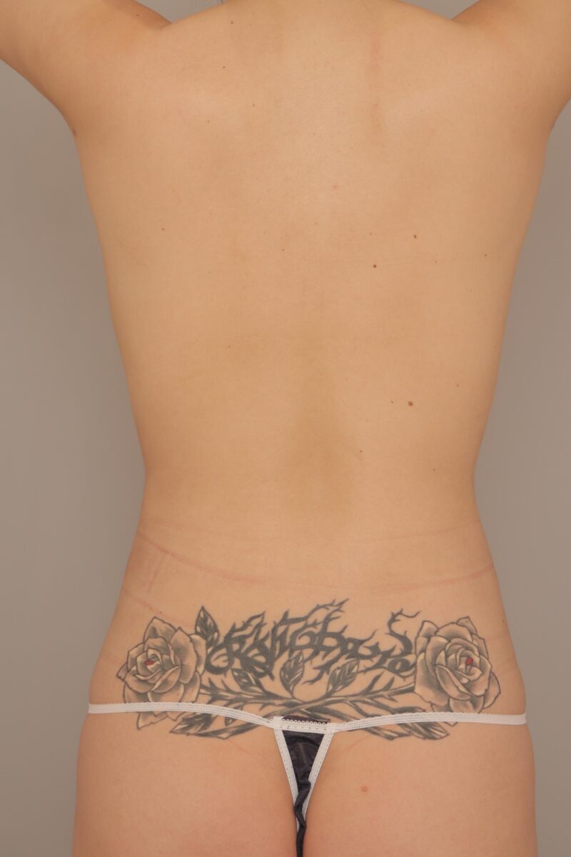 お腹全体胸下腰の脂肪吸引3ヶ月後♡