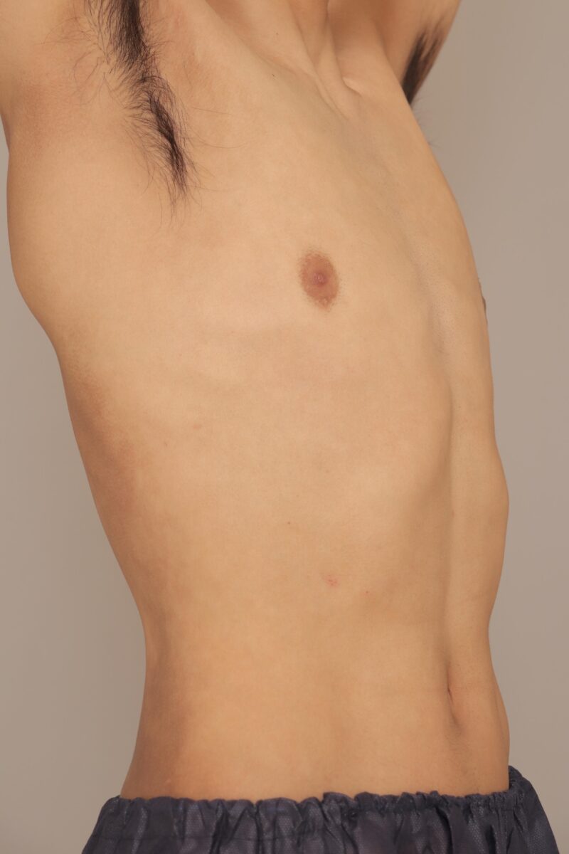男性のお腹・腰の脂肪吸引 術後6ヵ月の経過