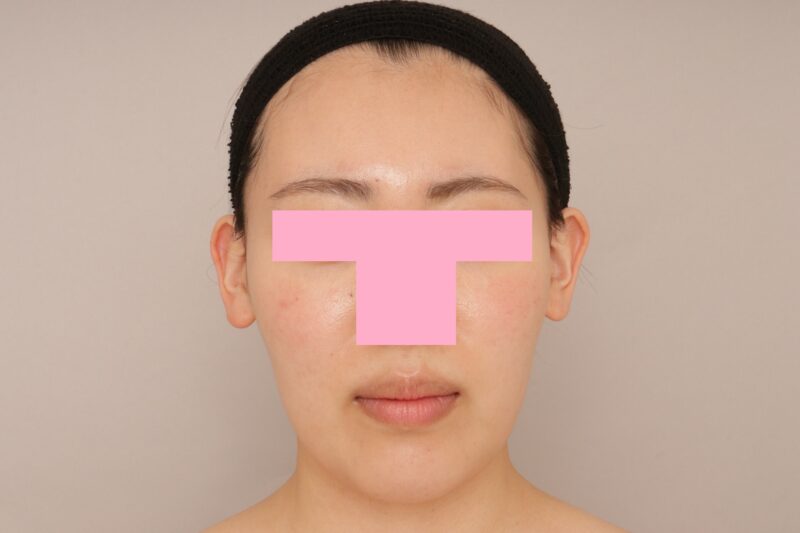 ベイザー脂肪吸引（3か月経過：25）の術前写真