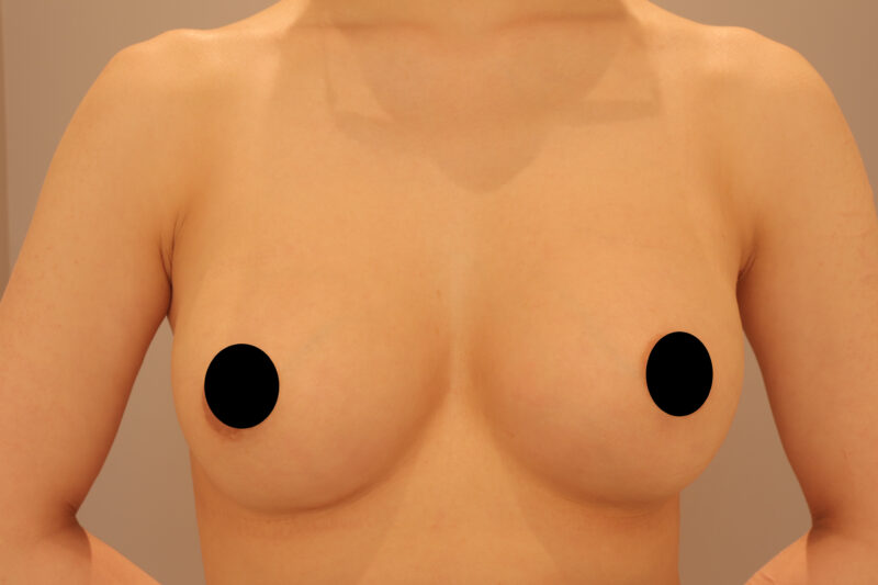 シリコンバッグの見た目調整モニター様1ヶ月後♡