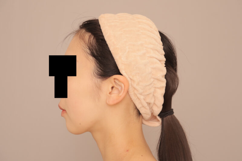 頬顎脂肪吸引でしゅっとしたフェイスラインに♡3ヶ月後