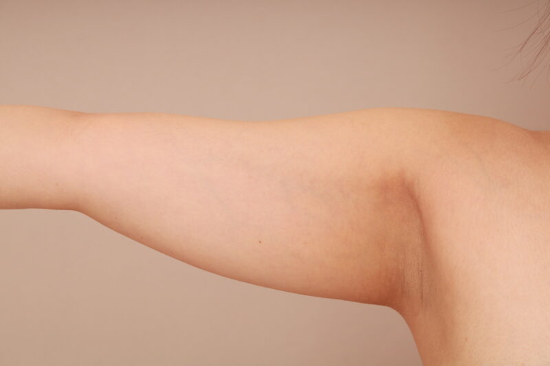 ベイザー脂肪吸引（6ヵ月経過：26）の術前写真