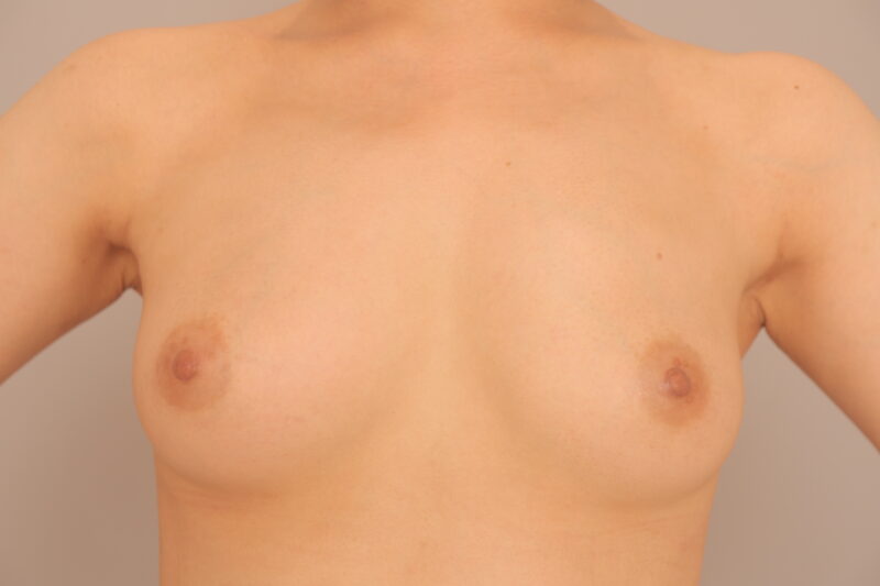 バストの左右差を調整し、脇肉吸引でますます美バストに♡