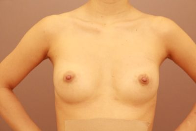 コンデンスリッチ豊胸+乳頭縮小