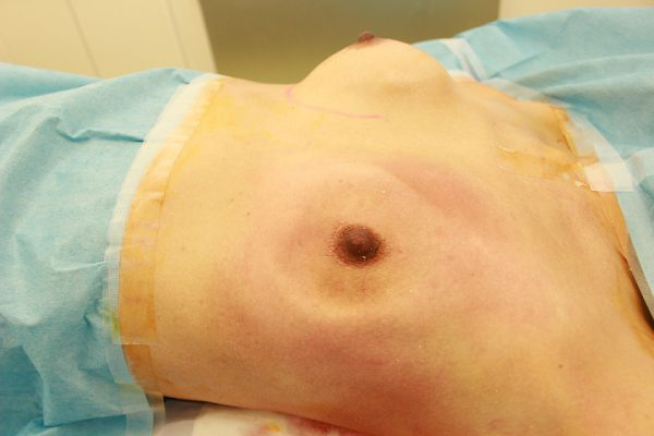 カプセル拘縮が強いかたの手術