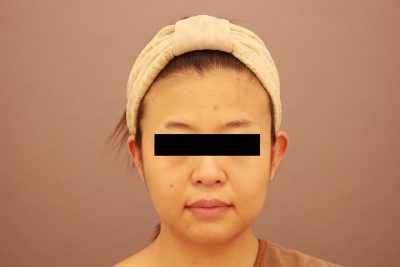 顔の脂肪吸引 まとめ