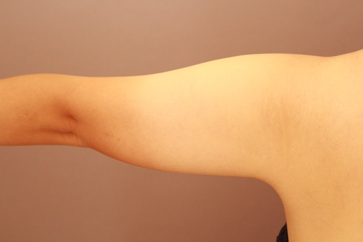 二の腕の脂肪吸引 半年経過