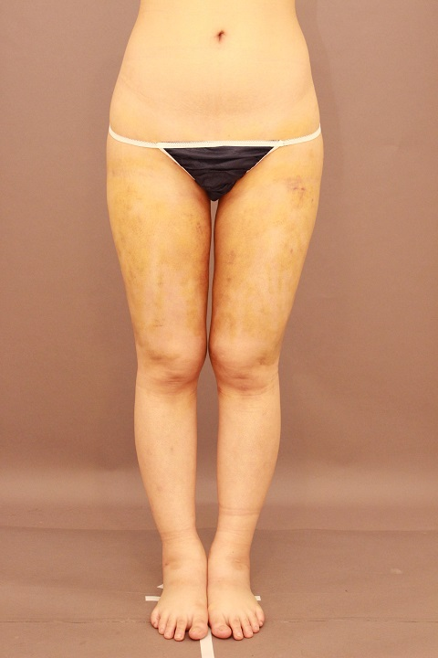 太ももの脂肪吸引 1週間後の状態