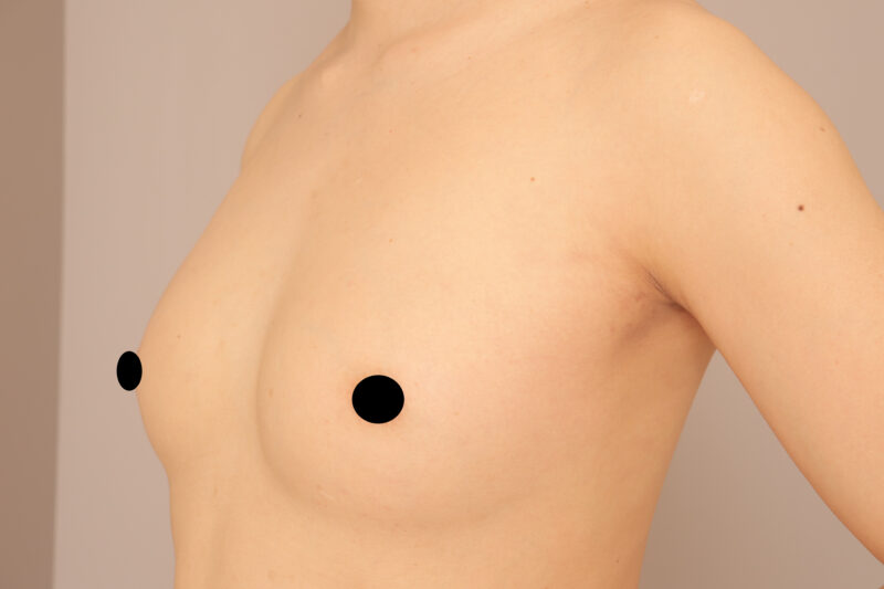 凍結脂肪使用！！元男性（ホルモン治療無し性転換手術無し）のコンデンスリッチ豊胸半年後