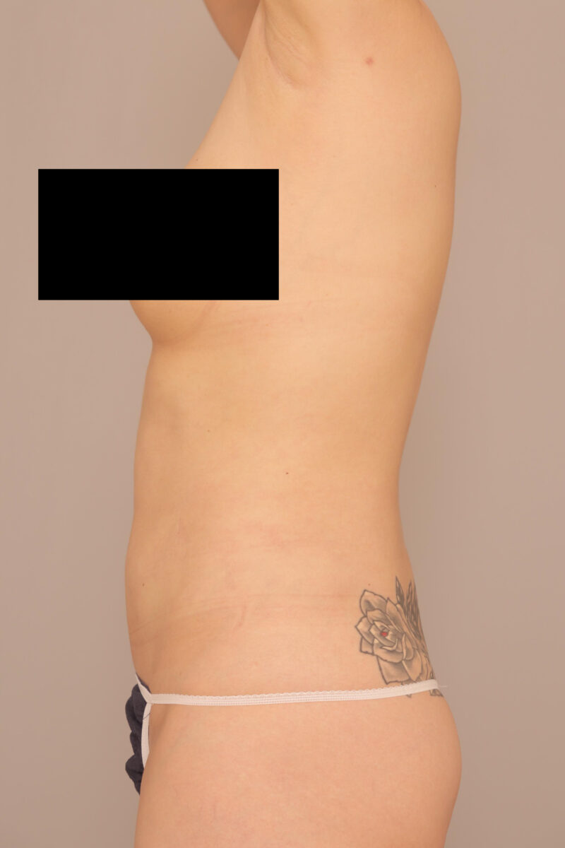 お腹まわりスッキリ!お腹全体胸下腰の脂肪吸引半年後♡