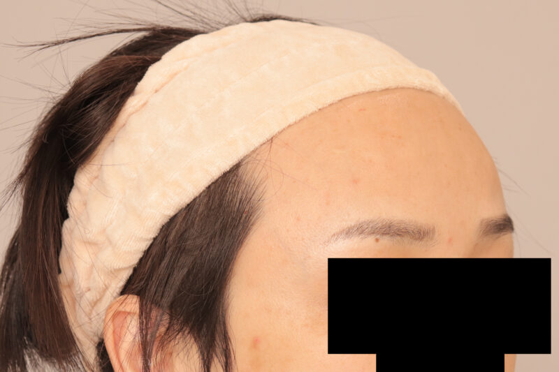 おでここめかみの脂肪注入でより可愛らしい印象に♡半年後