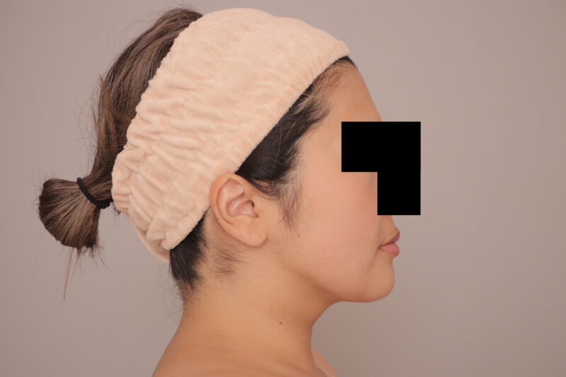 ママさんの頬顎脂肪吸引3ヶ月後♪見惚れるフェイスラインに♡