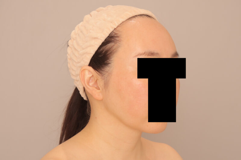 50代モニター様のおでここめかみ注入3ヶ月後♡