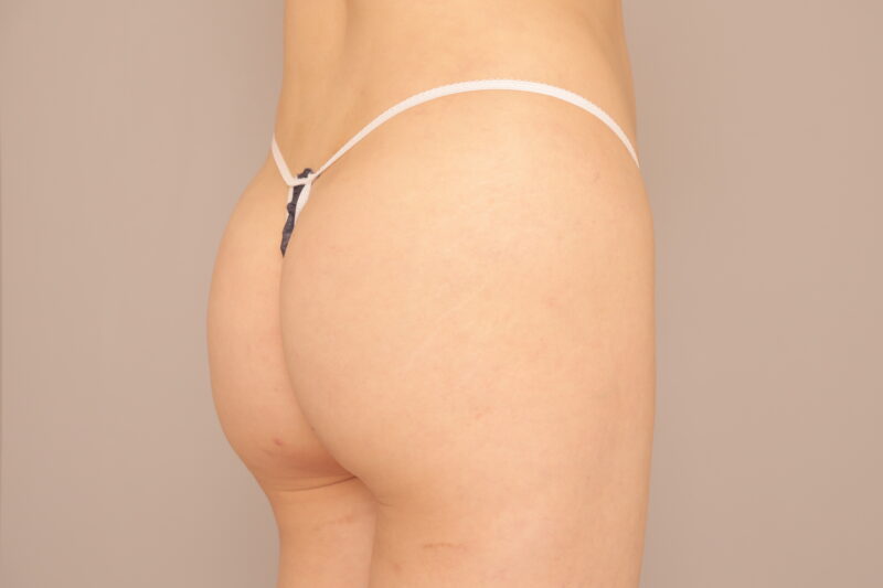 ブラジリアンバットリフトのモニター様半年後