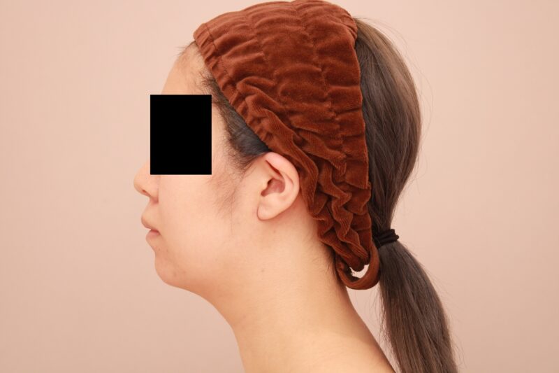 お顔の脂肪吸引 術後3カ月の経過